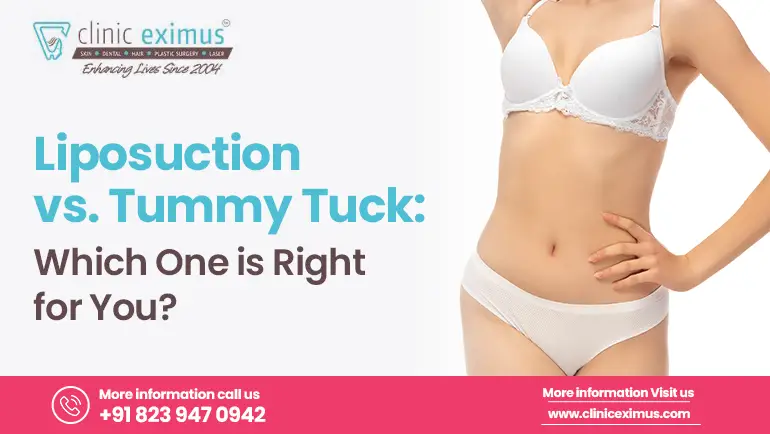 liposuction-vs-tummy-tuck-which-is-right-for-you